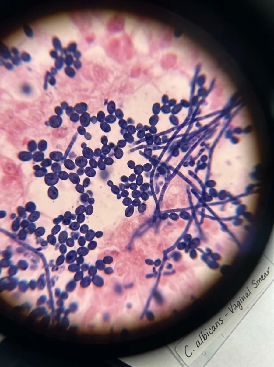 Candida albicans vaginal smear seen under a microscope.